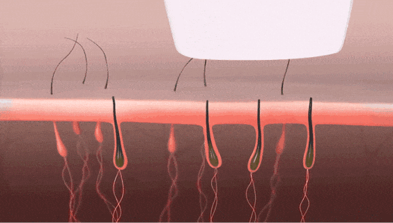 光子美容仪脱毛效果图