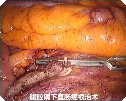 腹腔镜下直肠癌无荧光效果